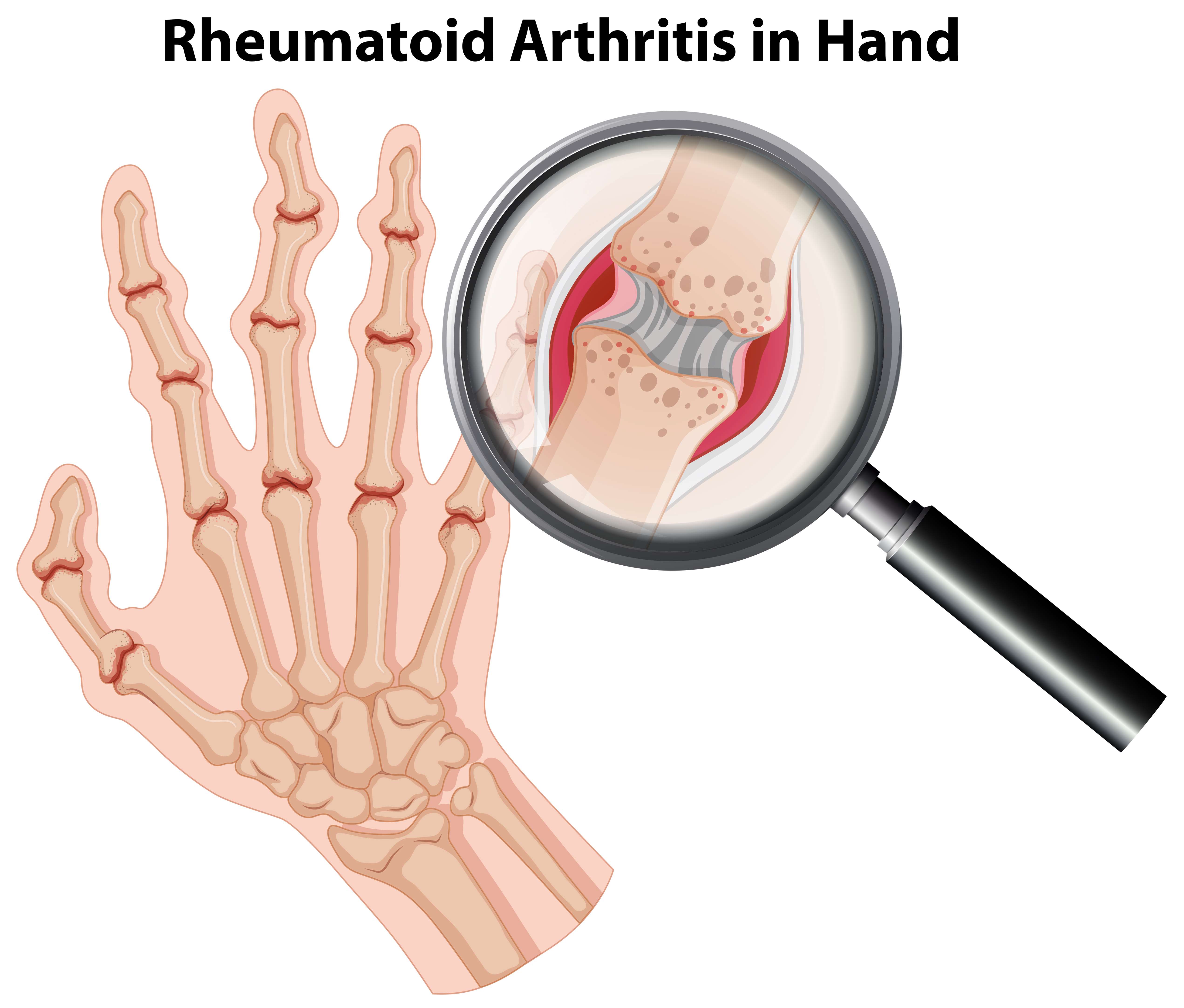 Rheumatik Arthritis
