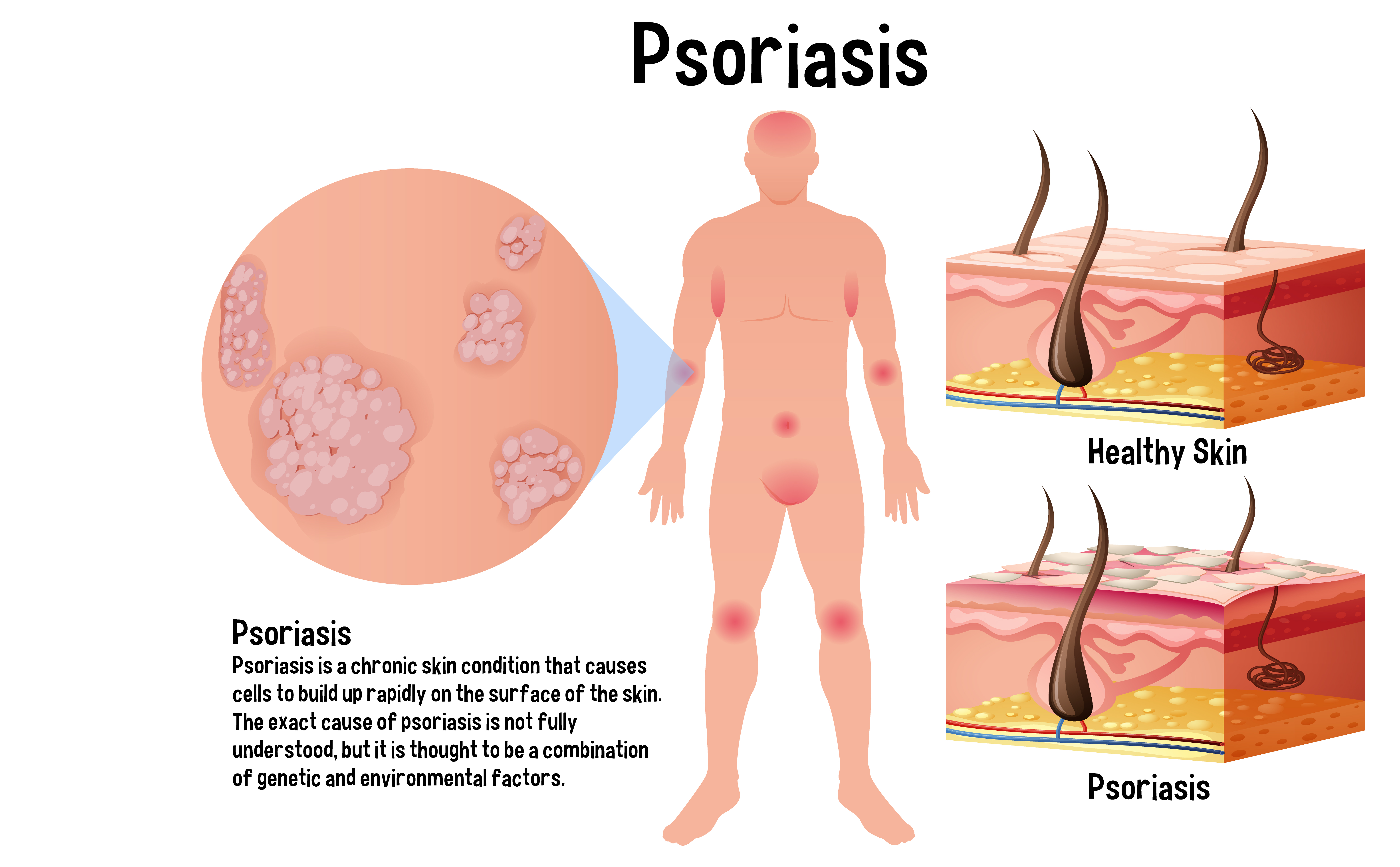 Psoriasis Vulgaris