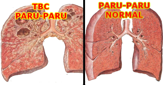 Penyakit Tuberkulosis Paru (TB Paru) Dapat Disembuhkan