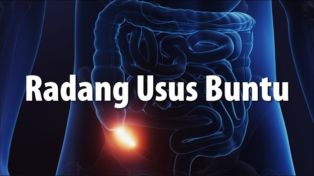 Mengenal Appendicitis: Jangan Sepelekan Nyeri Perut Kanan Bawah